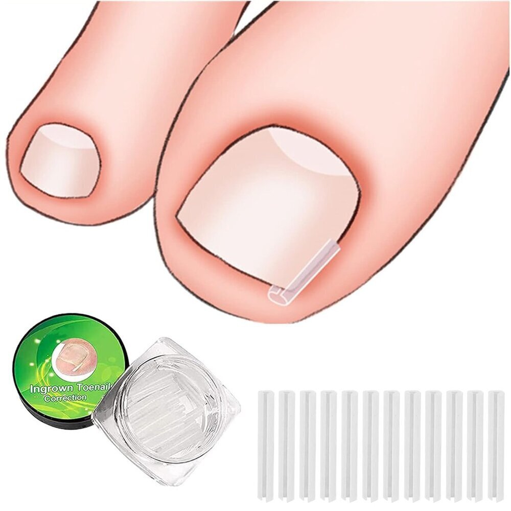 30+2 Pack Kit, 30PCS Ingrown Toenails Corrector Strips Brace Ingrown Toenail Ped - Picture 6 of 6